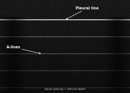 Schematic of A-lines below the pleural line