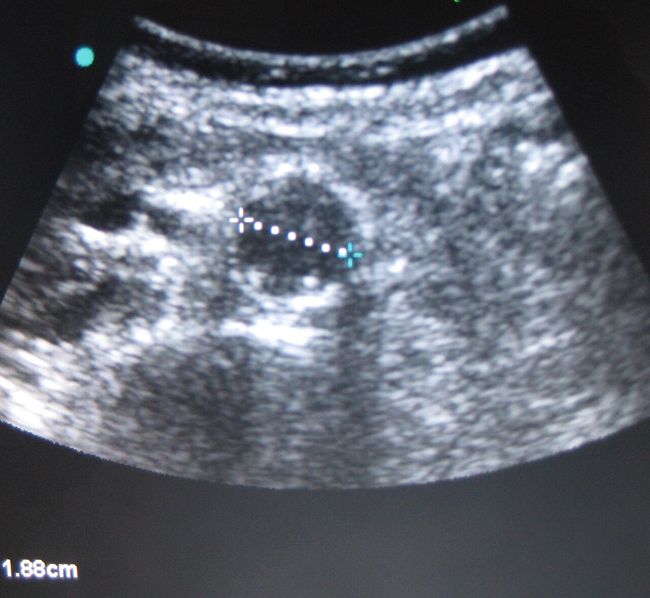 Normal abdominal aorta on ultrasound