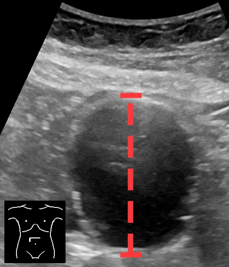 Abdominal aortic aneurysm, axial view