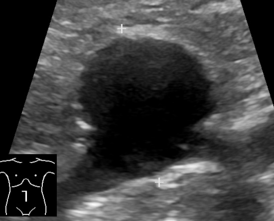 Saccular abdominal aortic aneurysm