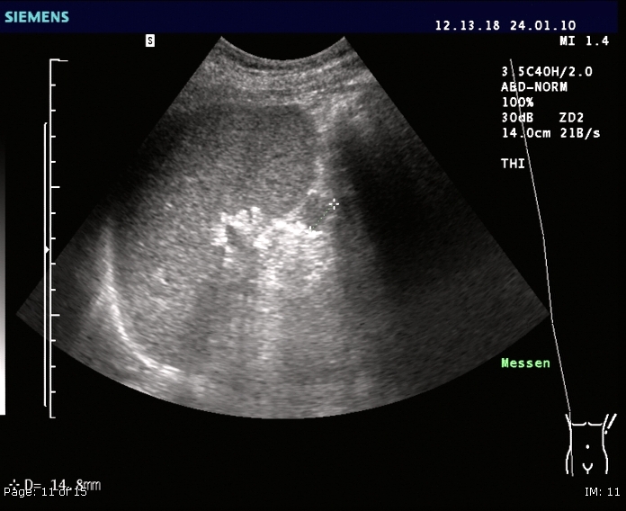 Ultrasound image of an accessory spleen sitting near the splenic hilum