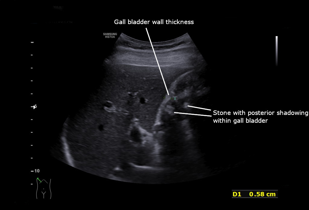 Ultrasound of acute cholecystitis showing a thickened gallbladder wall and stone