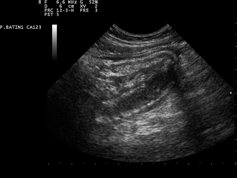 Ultrasound of an inflamed appendix in cross section