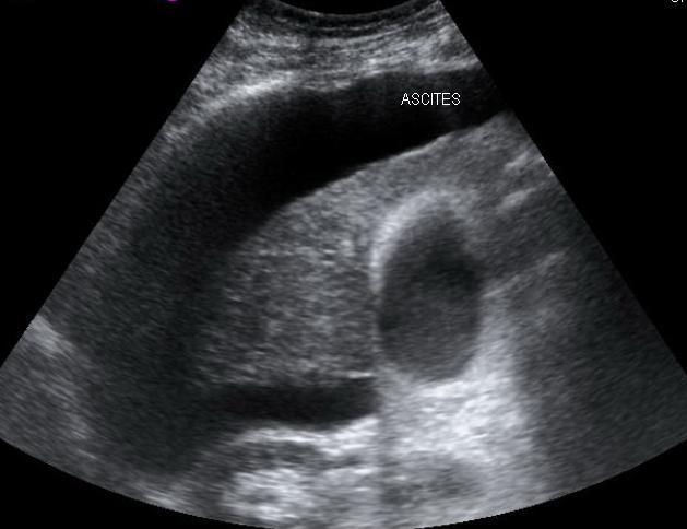 Ultrasound image showing a cirrhotic liver with ascites surrounding it