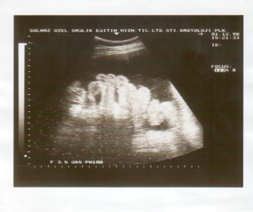 Ultrasound scan showing a large peritoneal fluid pocket with bowel loops floating within it