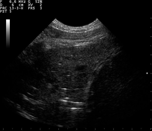 Wet lung on ultrasound showing B-lines
