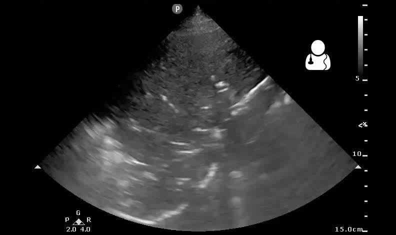 Lung ultrasound in a hypoxic breathless patient