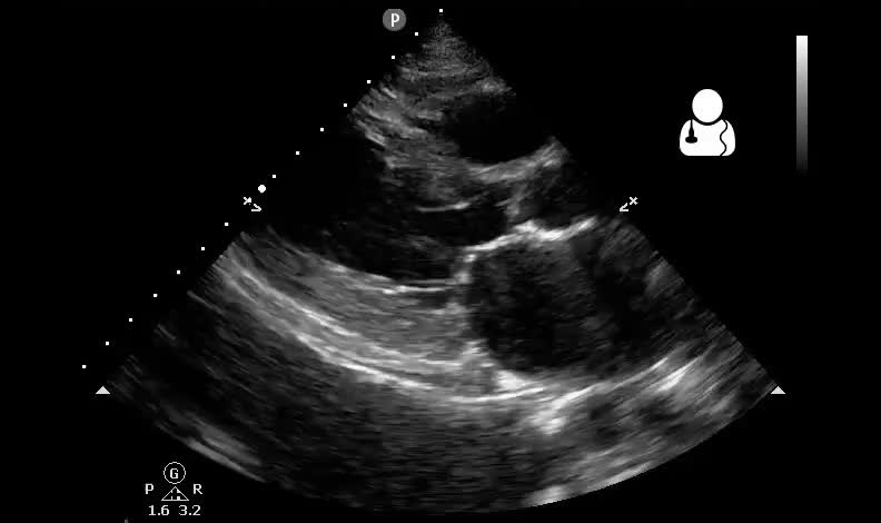 Lung ultrasound in a patient short of breath