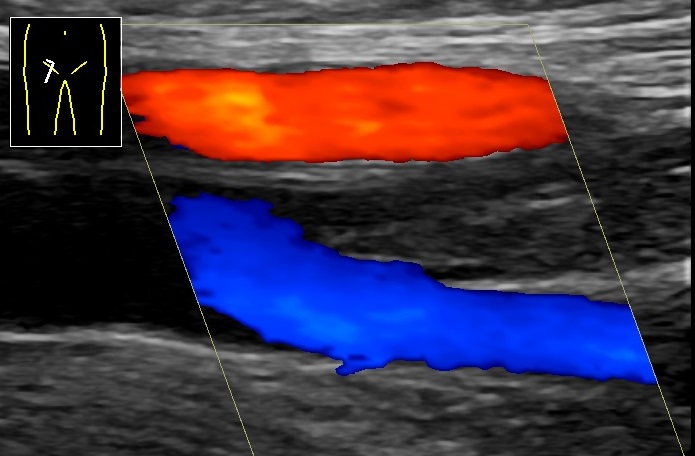 Doppler ultrasound of deep vein thrombosis