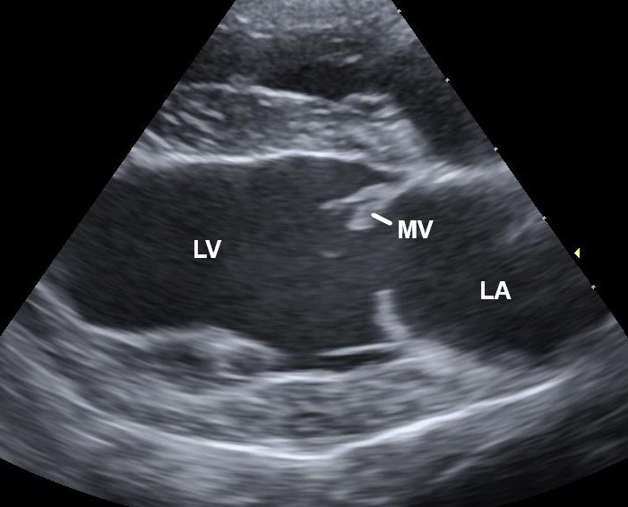 Echocardiogram of a dog with degenerative mitral valve disease showing thickened mitral leaflets
