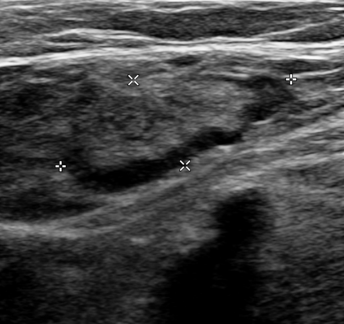 Non-compressible femoral vein on ultrasound
