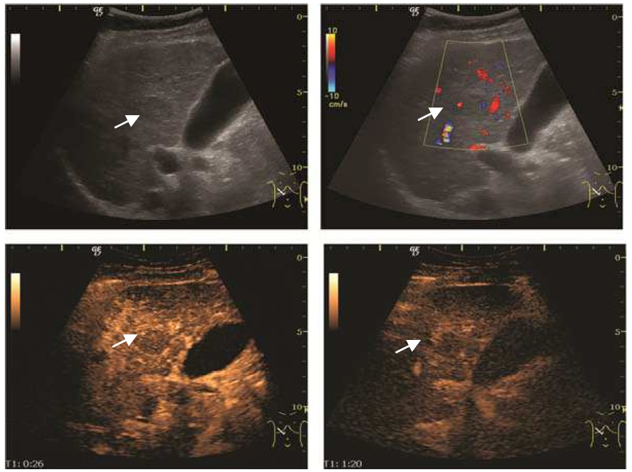 Contrast-enhanced ultrasound of a dysplastic nodule in the liver showing arterial and portal phase washout patterns