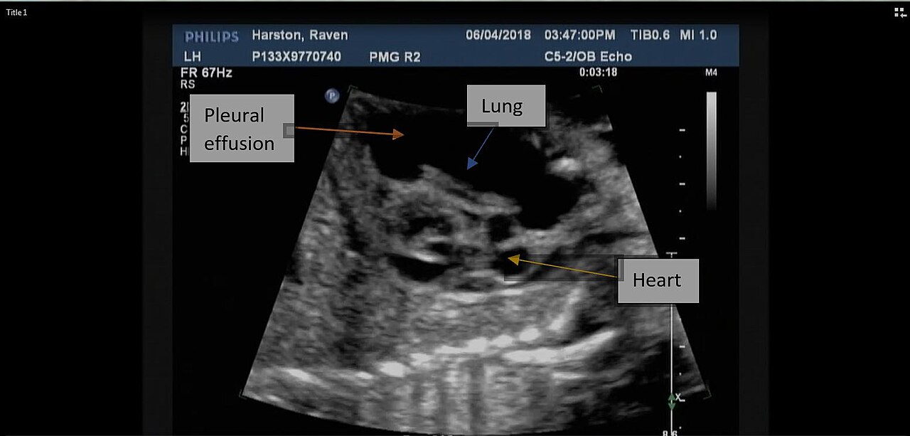 A focused chest ultrasound view