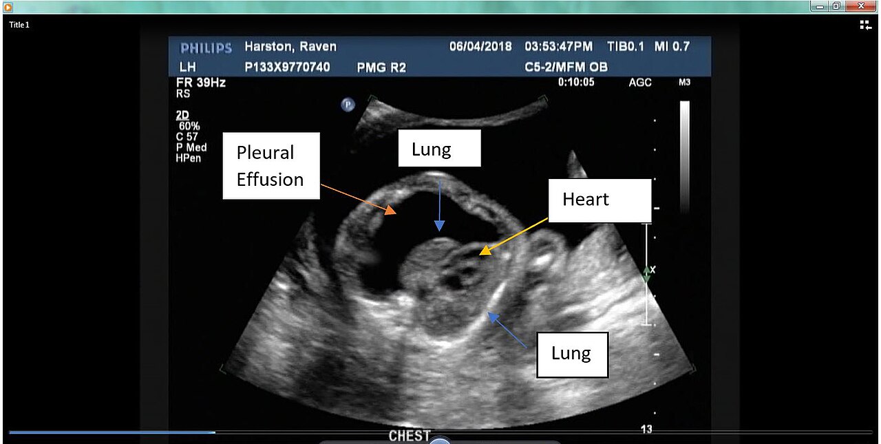 A focused lung ultrasound view of the pleura