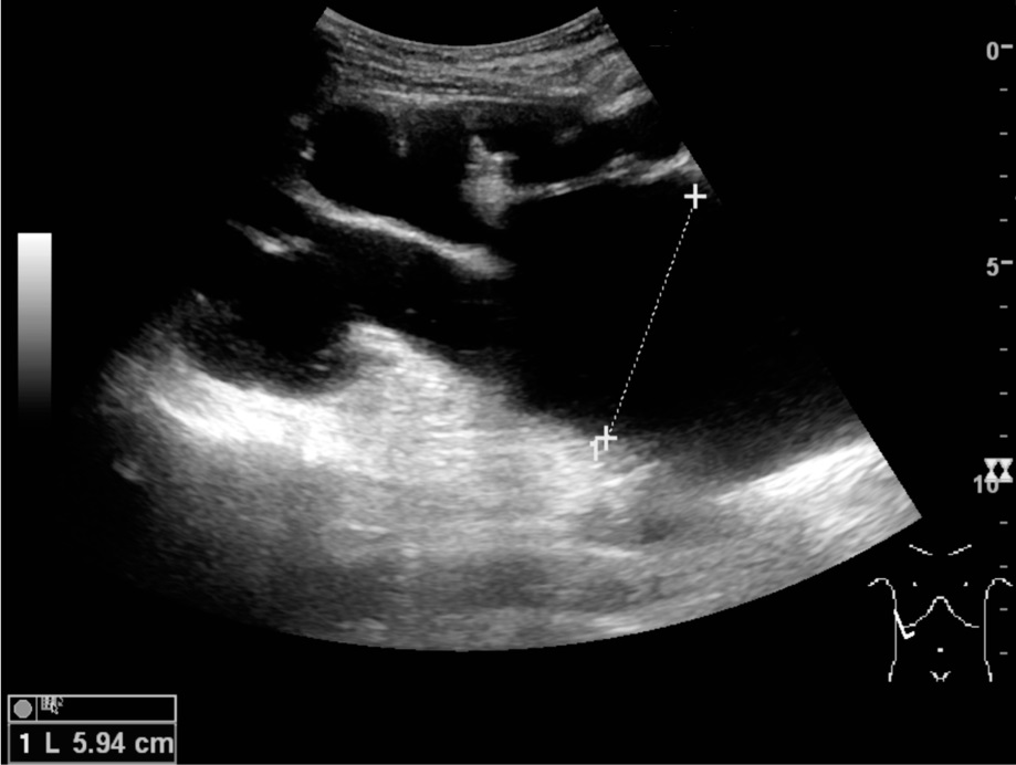 Ultrasound of severe end-stage hydronephrosis with thinned renal cortex