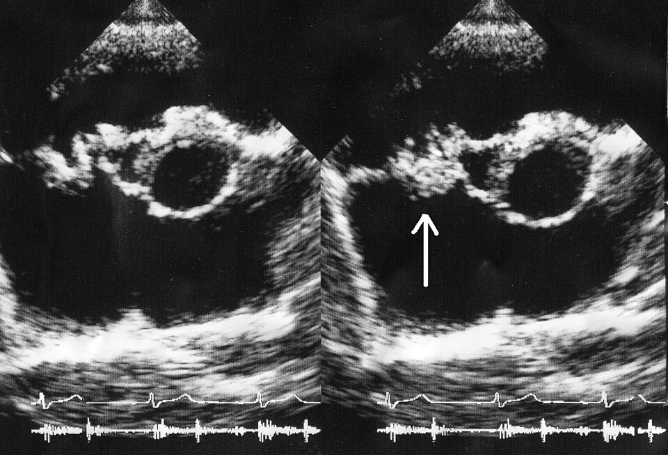 Vegetation on echocardiography