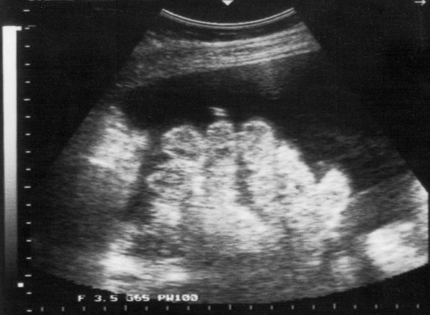 A dark pocket of fluid between organs on a focused scan