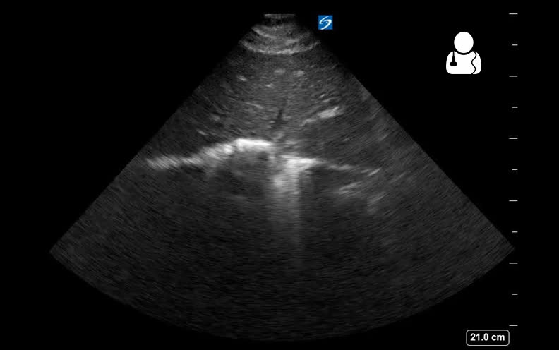 A FAST ultrasound view showing free fluid as a dark stripe