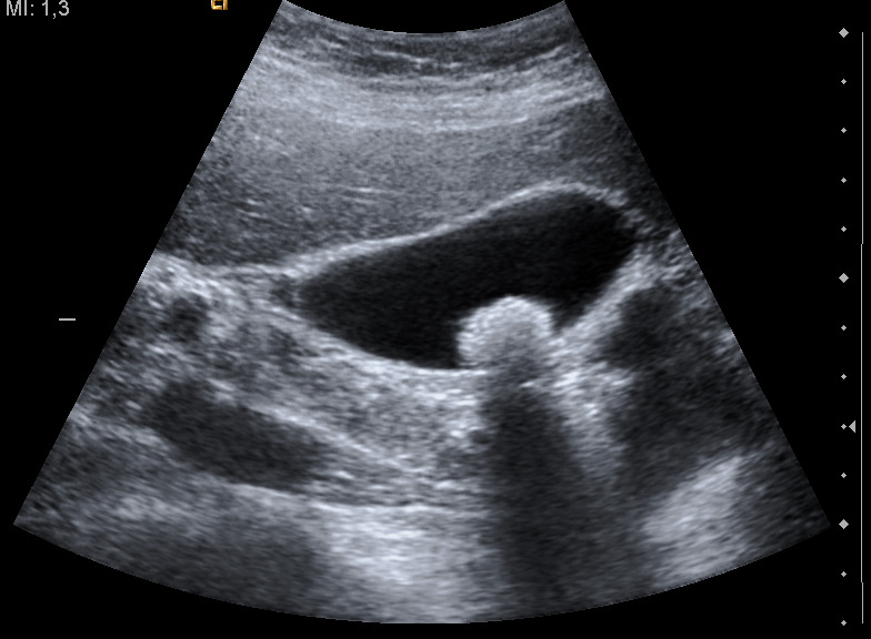 Ultrasound of a gallbladder stone, a bright focus casting a posterior acoustic shadow