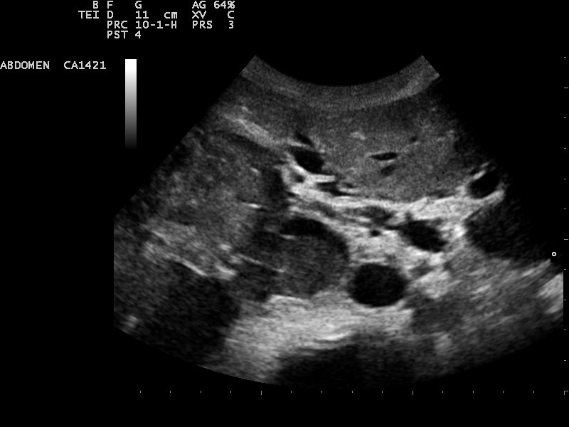 B-mode ultrasound image of a hepatocellular carcinoma in the liver showing a heterogeneous mass