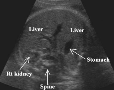 Ultrasound view of an enlarged spleen alongside enlargement of the liver