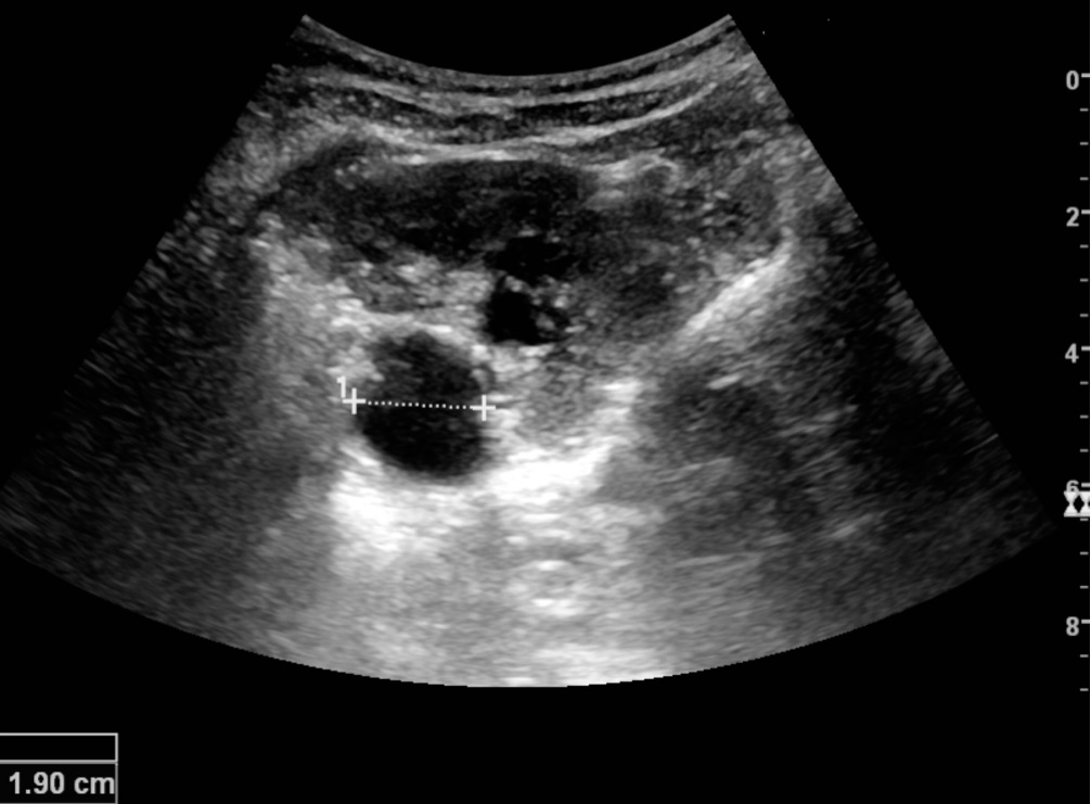 Ultrasound of a kidney with hydronephrosis, the renal pelvis and calyces dilated into dark pockets