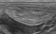 handheld ultrasound B-mode scan of soft tissue