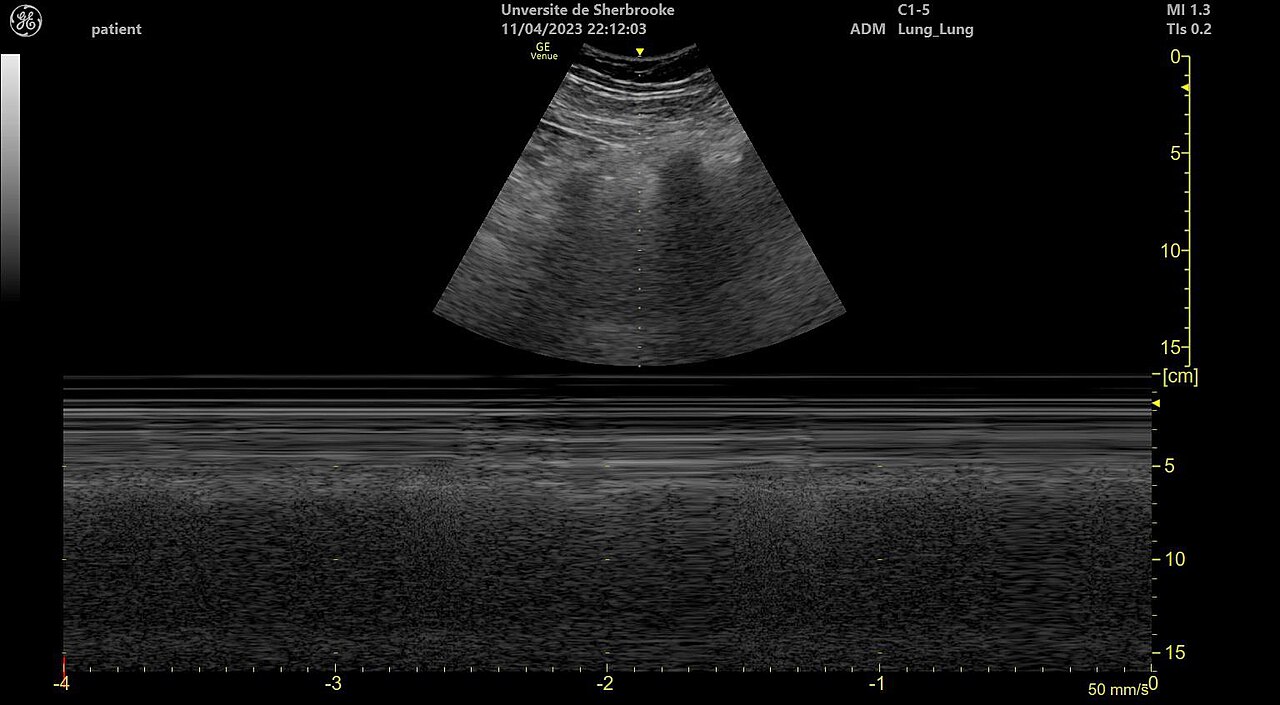ultrasound image produced by a handheld probe shown on screen