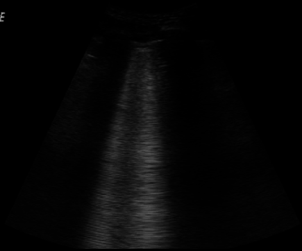 lung ultrasound image acquired at the bedside