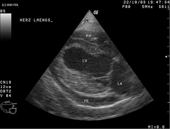 point of care ultrasound image of fluid around the heart