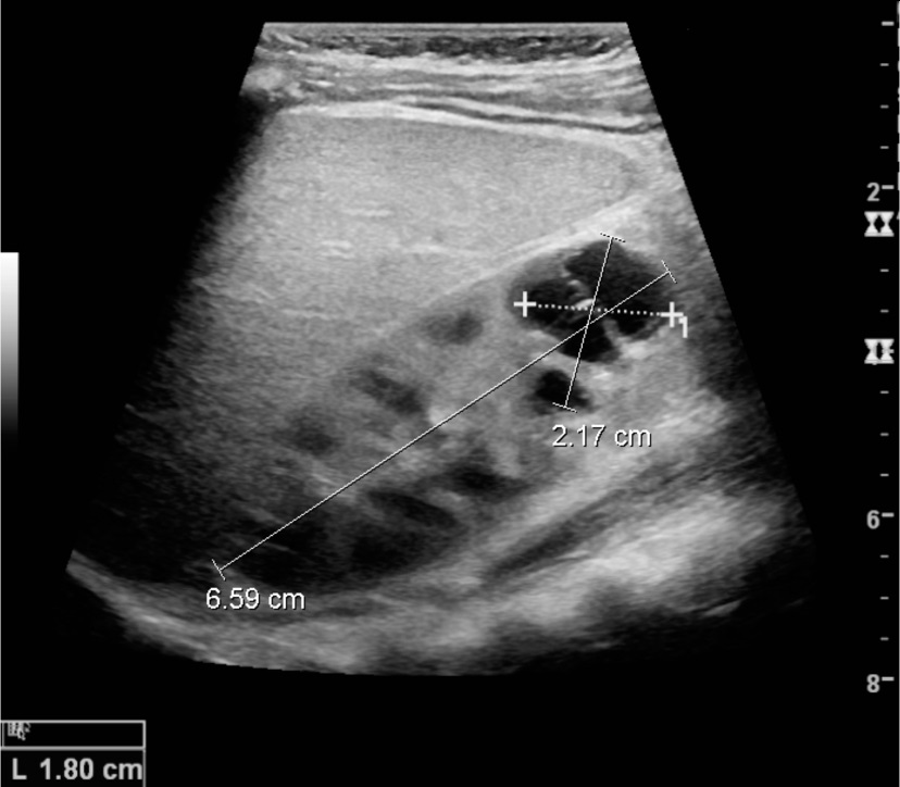 ultrasound scan of a complex cyst with internal membranes