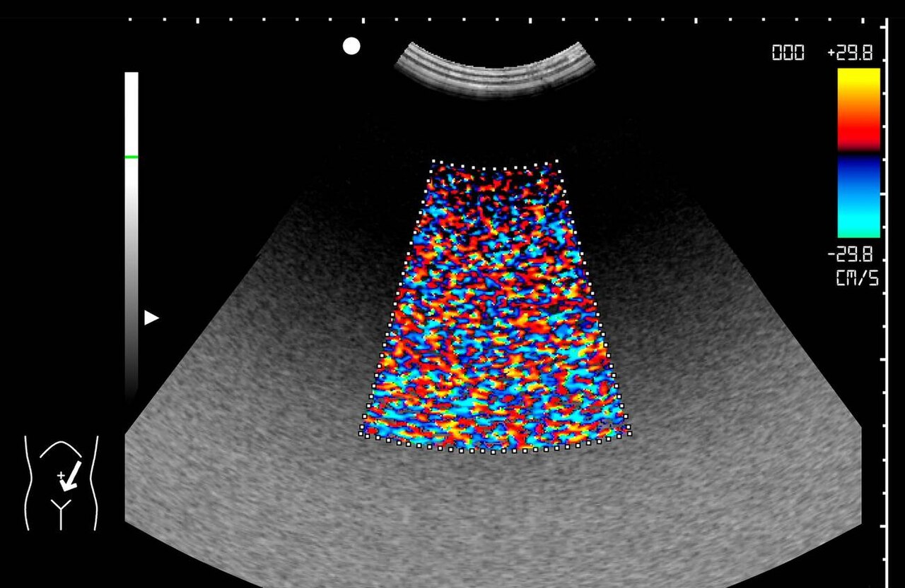 color Doppler ultrasound image showing flow with artifact