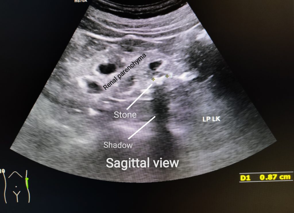 Ultrasound of a left kidney showing a stone in the lower pole with posterior acoustic shadow