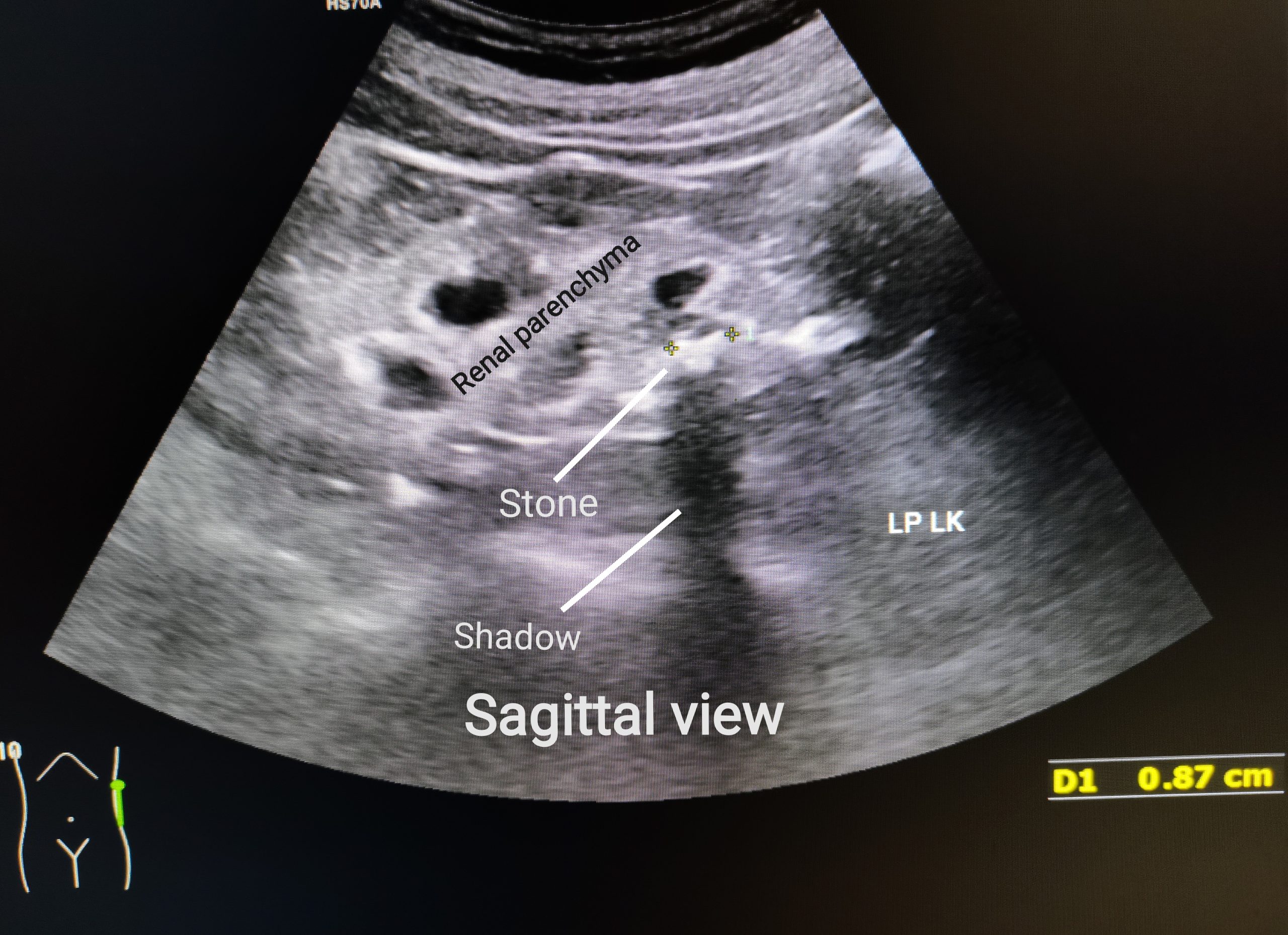 Ultrasound of a left kidney showing a stone in the lower pole with posterior acoustic shadow