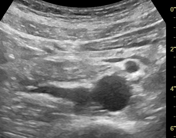 abdominal ultrasound scan