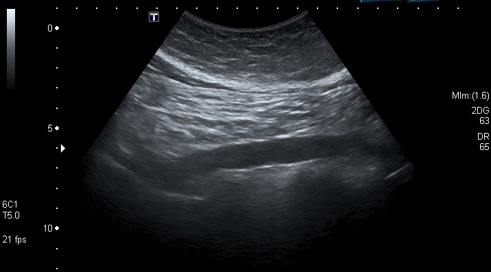 abdominal ultrasound scan