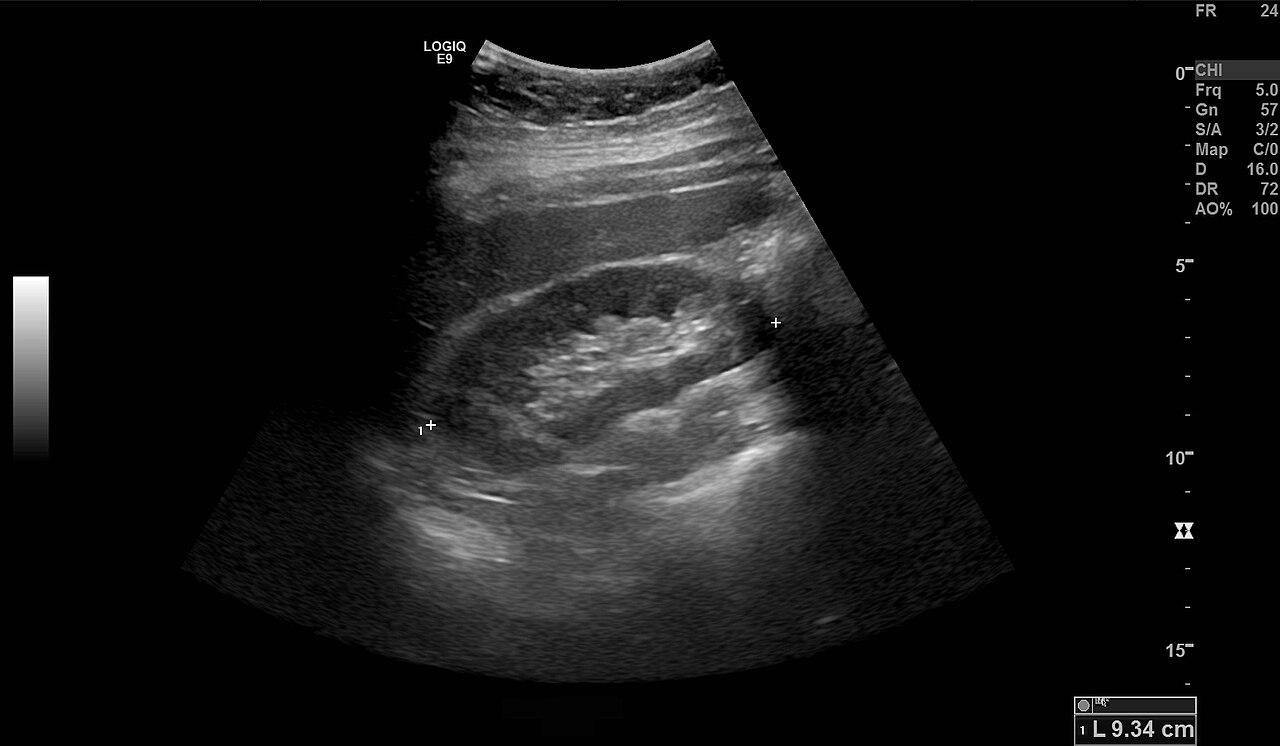 abdominal ultrasound scan