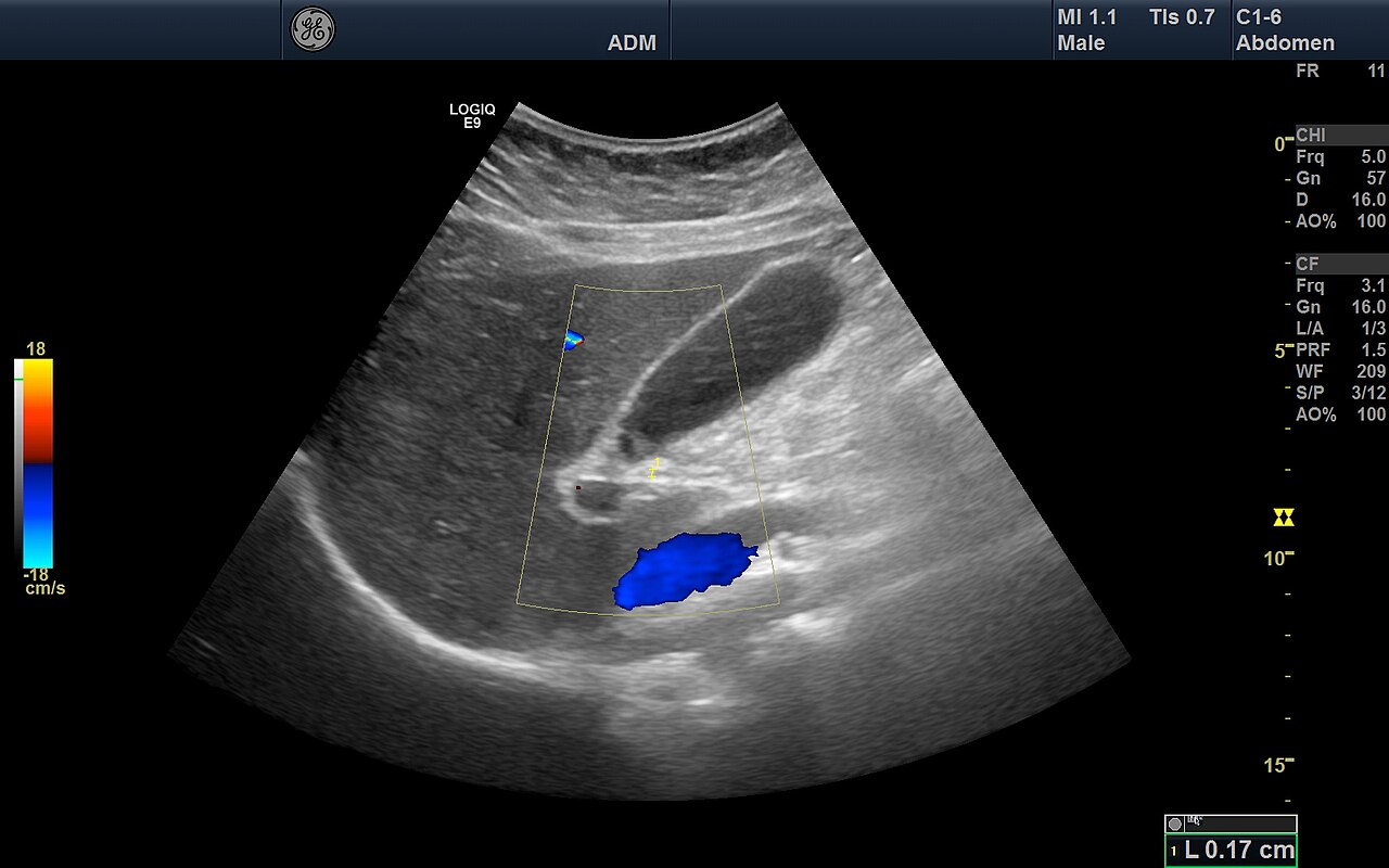 abdominal color flow scan