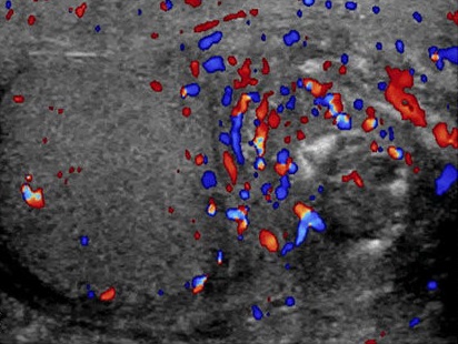 color doppler ultrasound scan