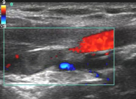 color doppler ultrasound scan