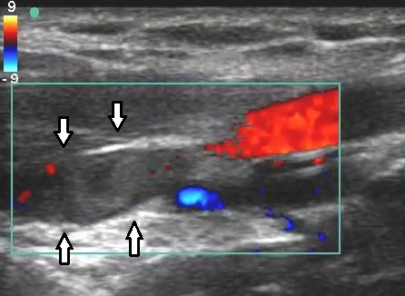 color flow ultrasound scan