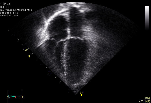 echocardiogram ultrasound