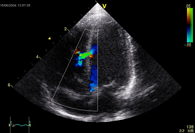 echocardiogram ultrasound