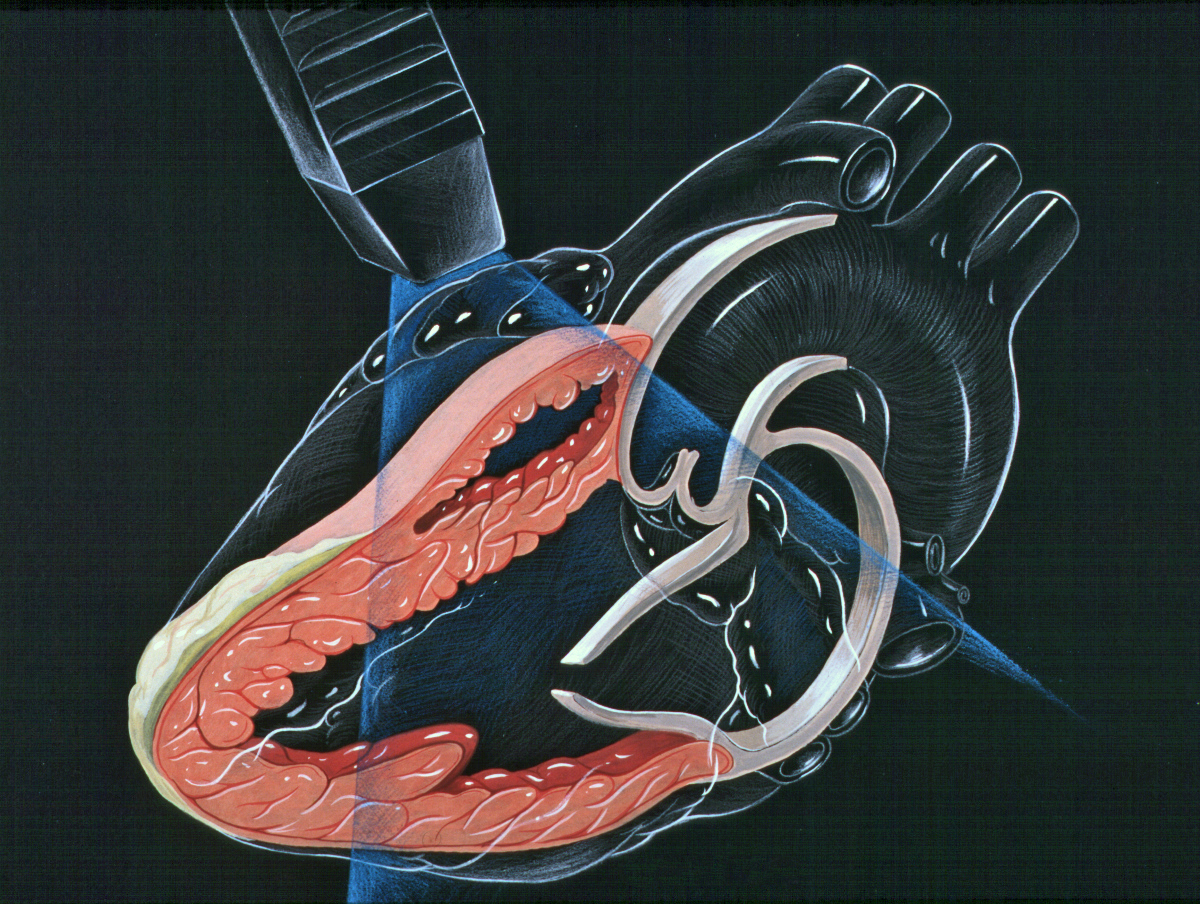 echocardiogram ultrasound