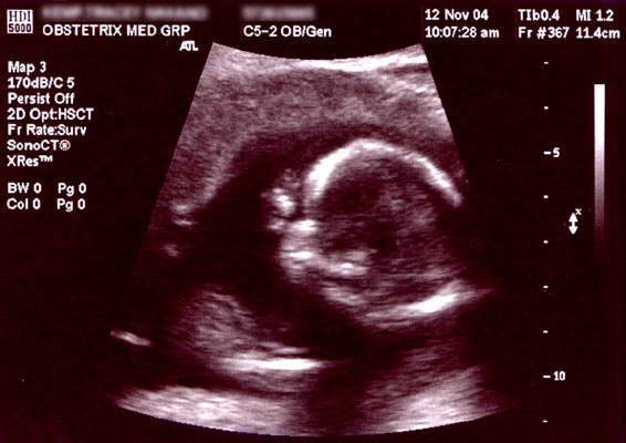 fetal ultrasound image