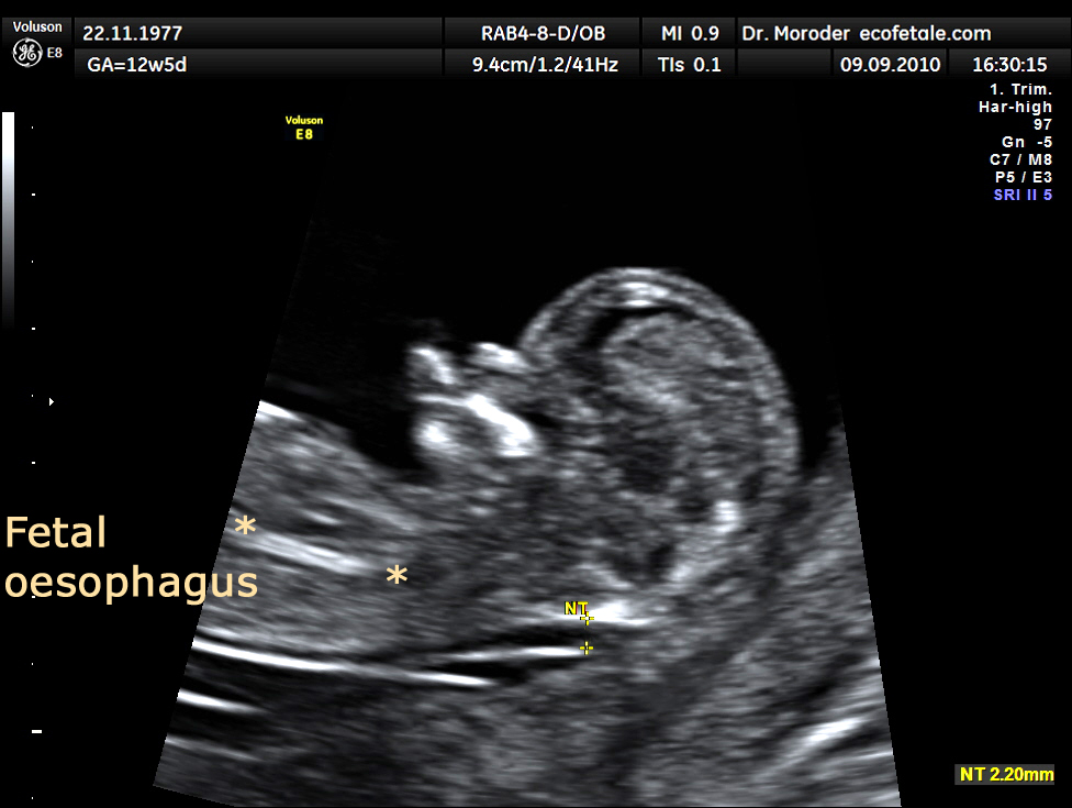 fetal ultrasound scan