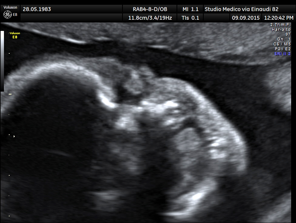 fetal ultrasound scan