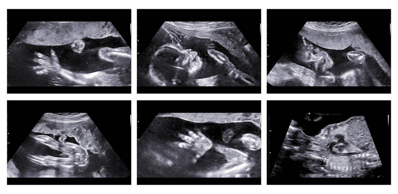 fetal ultrasound frames
