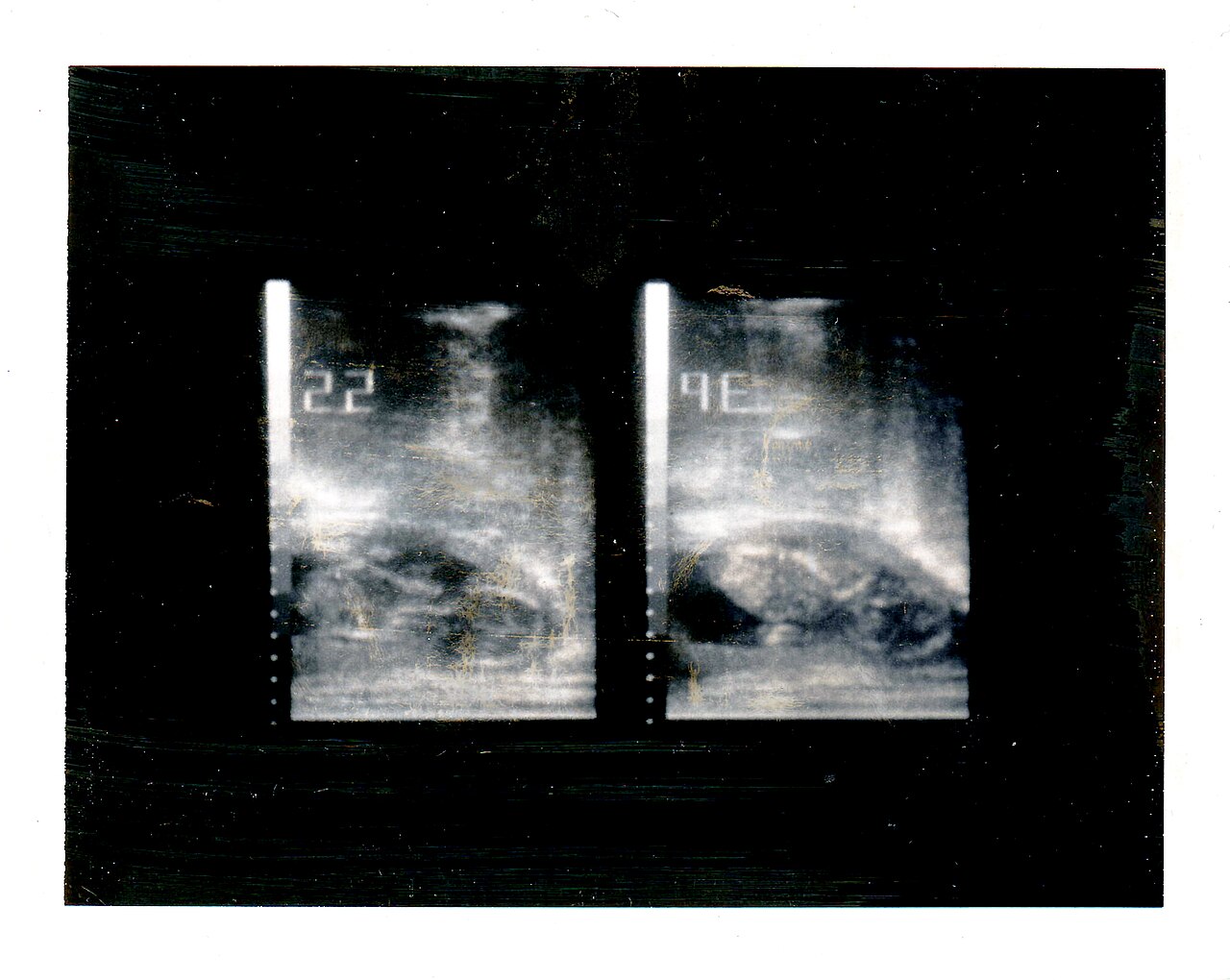 ultrasound scan image