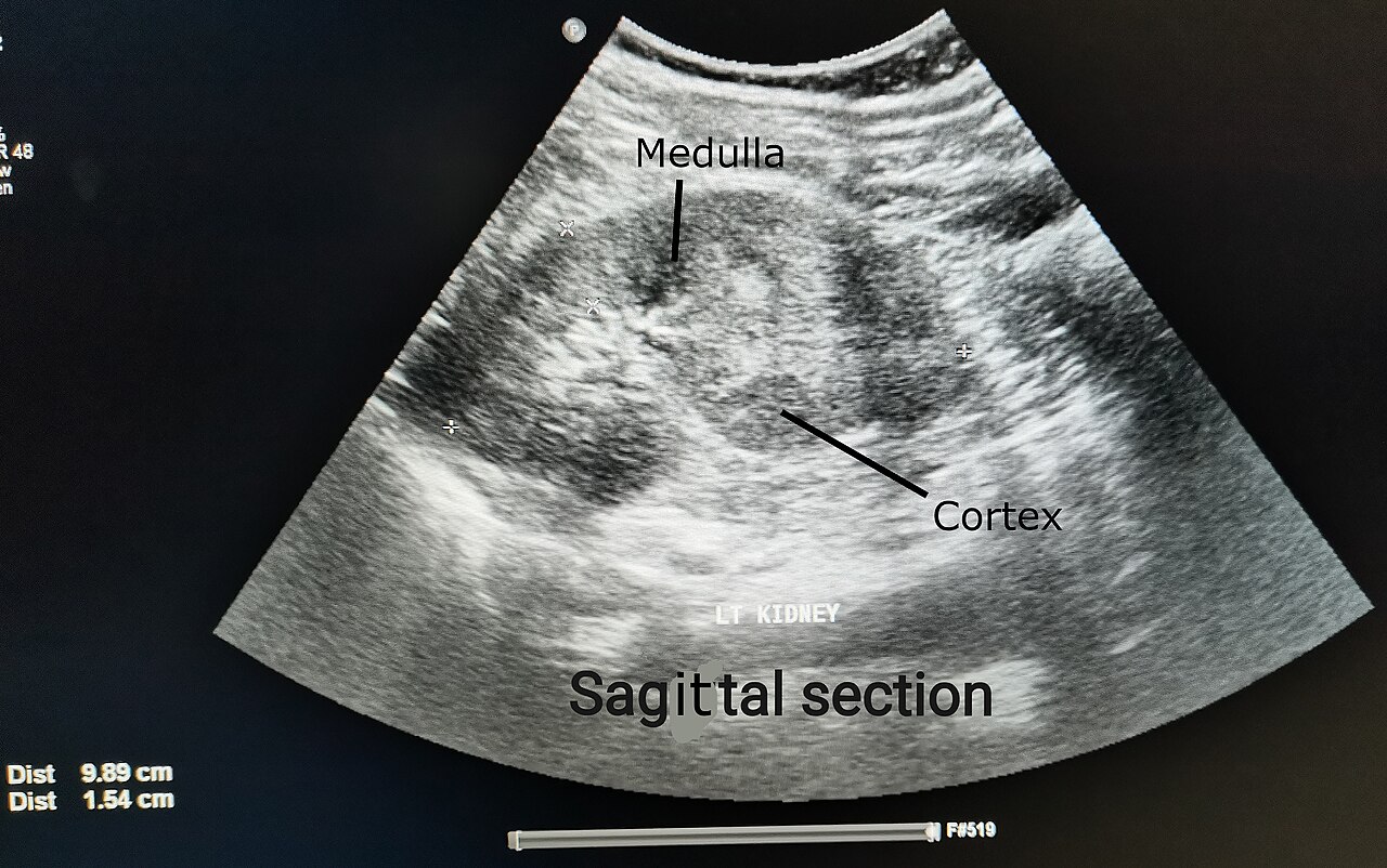 renal ultrasound scan